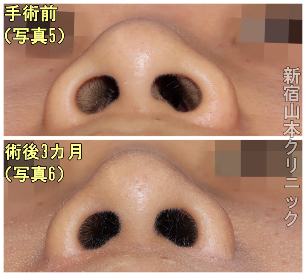 小鼻縮小って、笑っても小鼻が小さくなる！？ | 美容外科話 | 美容外科