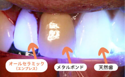 セラミック治療（オールセラミック）なら中央線三鷹駅前のハートフル