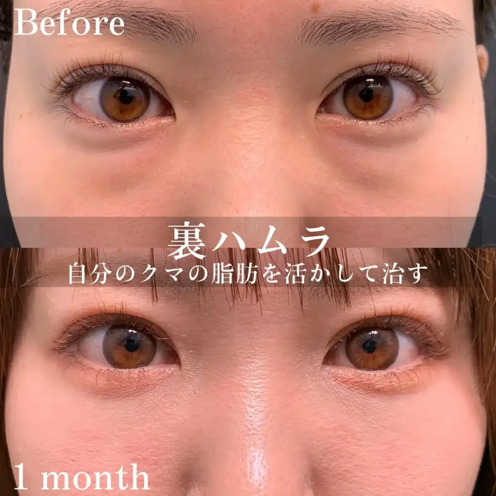 大阪梅田院のクマ取り・目の下のたるみ取り治療 | eクリニック大阪梅田