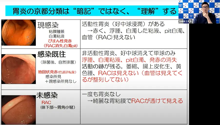 萎縮性胃炎とピロリ菌感染の診断、内視鏡所見も踏まえて解説