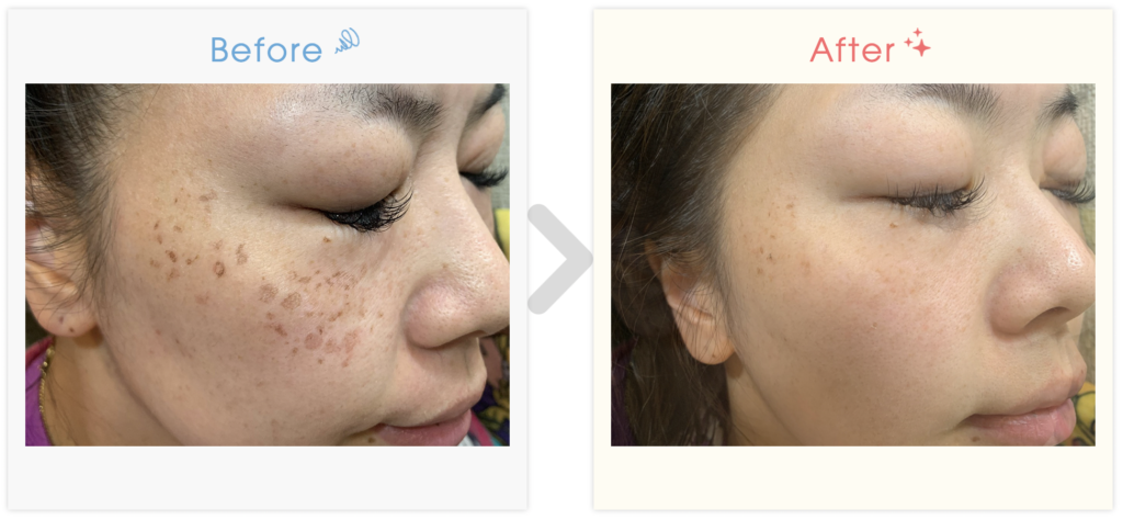 サロン導入可能なシミ取り機械を調査・比較してみました - 【公式