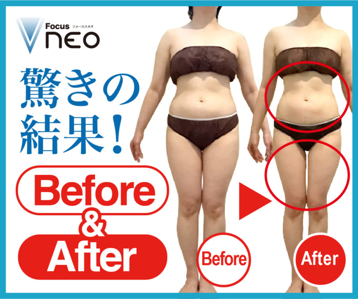 訳あり】Focus NEO A16（フォーカスネオ）4.5mmハイフヘッド付き 訳