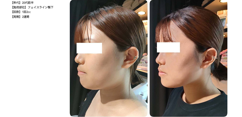 レモンボトル（10ml×5本）×5個セット 脂肪分解／脂肪溶解剤 - エステの