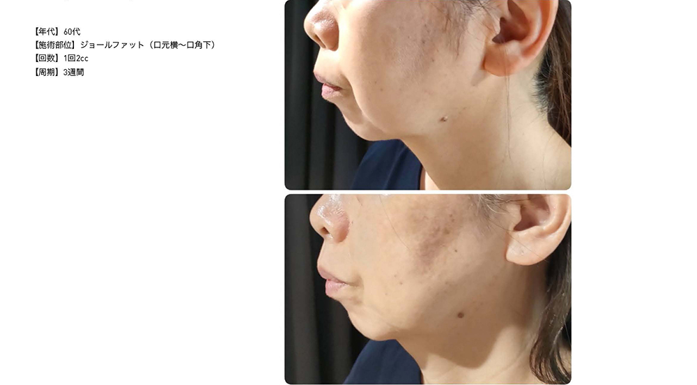 リピーター限定＞レモンボトル（10ml×5） 脂肪分解／脂肪溶解剤 特典付