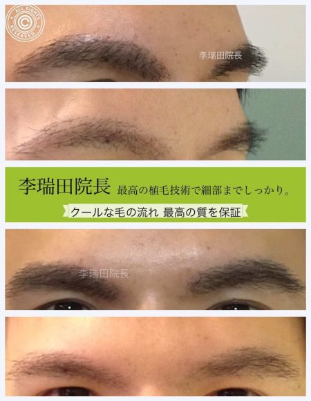 まゆげ | 李瑞田院長 精工眼美學