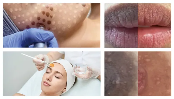 メソスキンカラー（導入セット/単品販売） | 業務用美容・エステ機器の