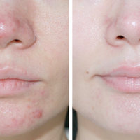 トリア / Acnery Clear Blue Lightの公式商品情報｜美容・化粧品情報は