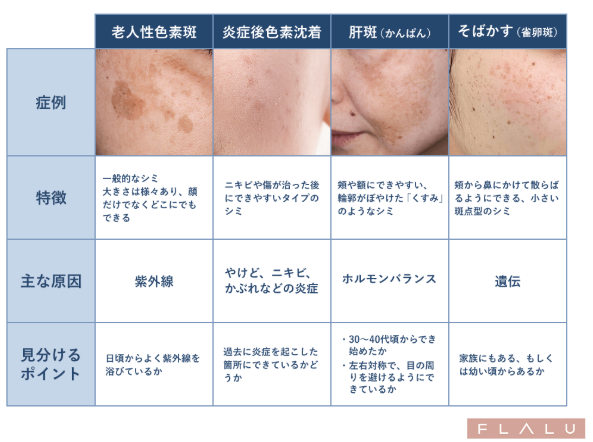 そばかすを消す・取る方法｜レーザー治療と自宅ケア・メイクで隠すコツ