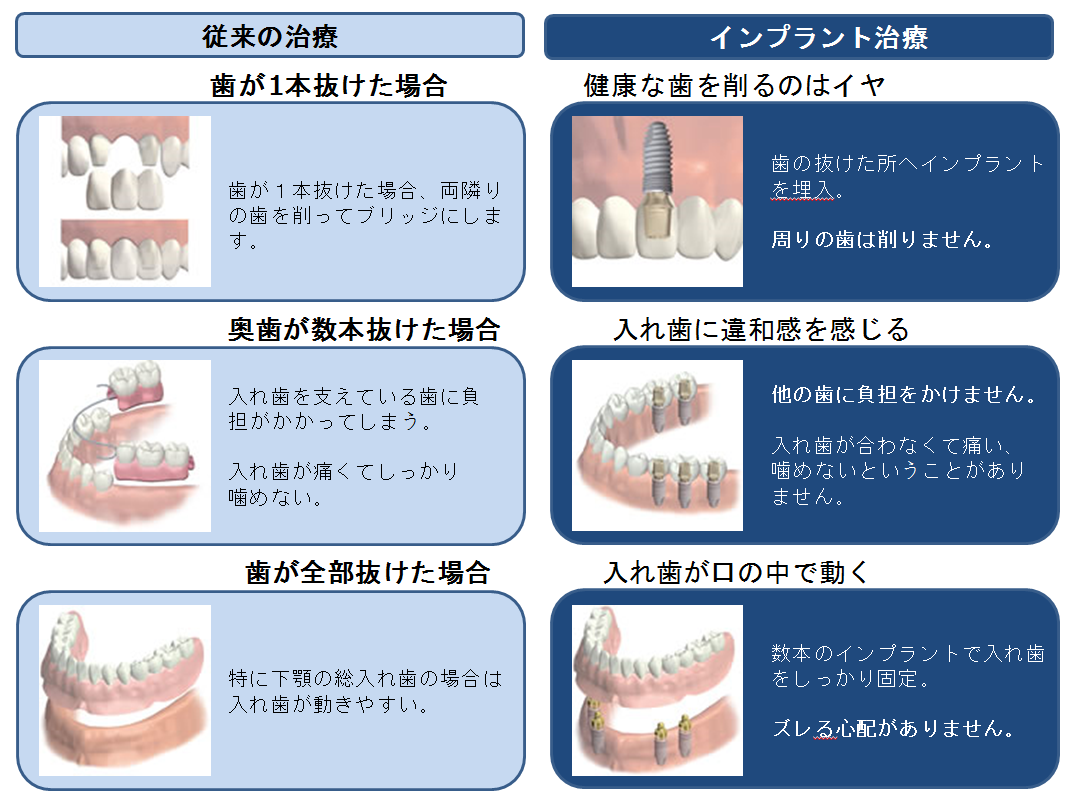 口腔インプラントセンター | 船橋中央病院 地域医療機能推進機構