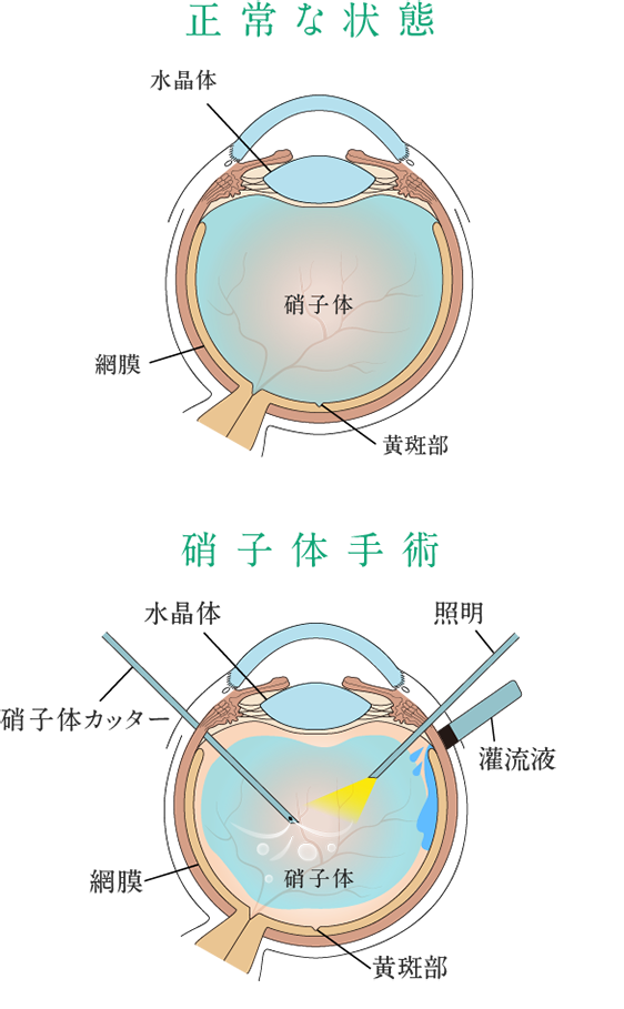硝子体と硝子体手術 | 日帰り硝子体手術 | 白内障・硝子体・緑内障手術