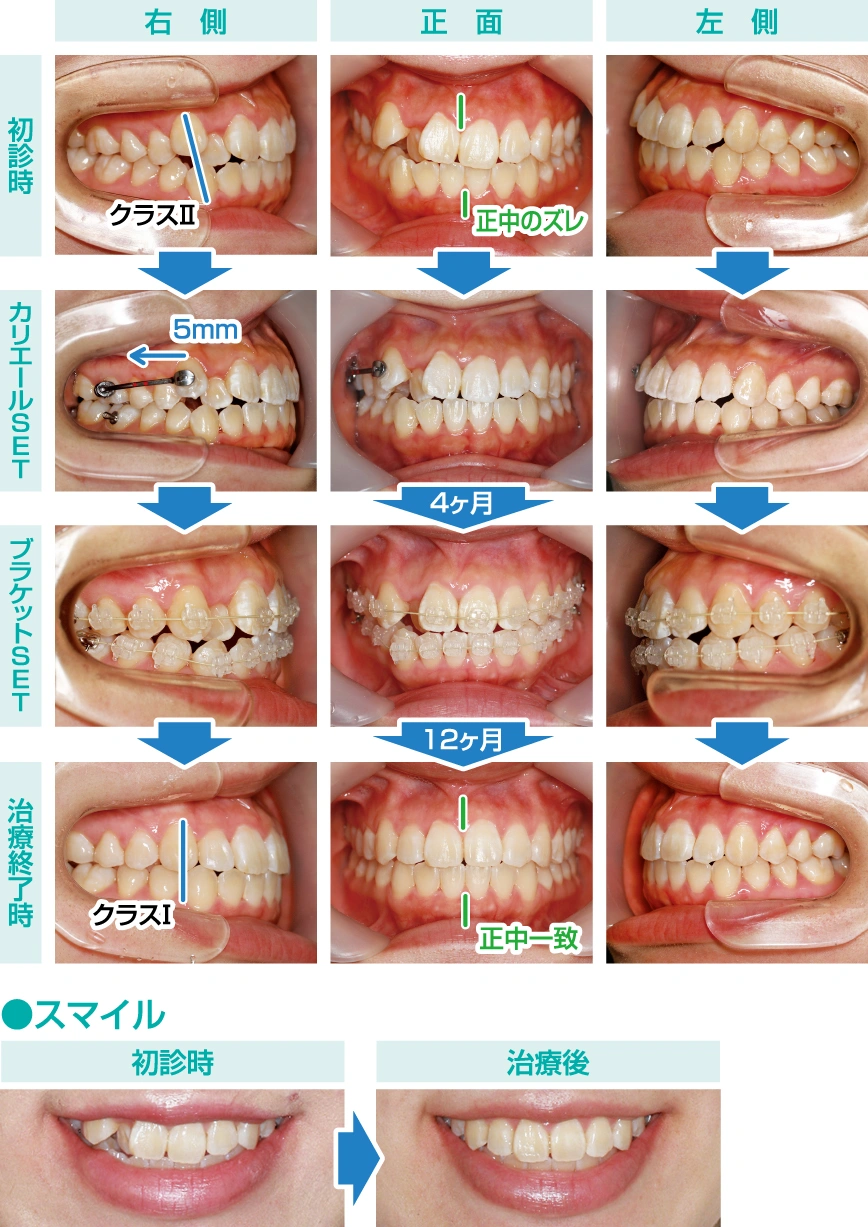 Vol.148 カリエールを用いた 非抜歯矯正治療No.5 | ふかつ歯科・矯正