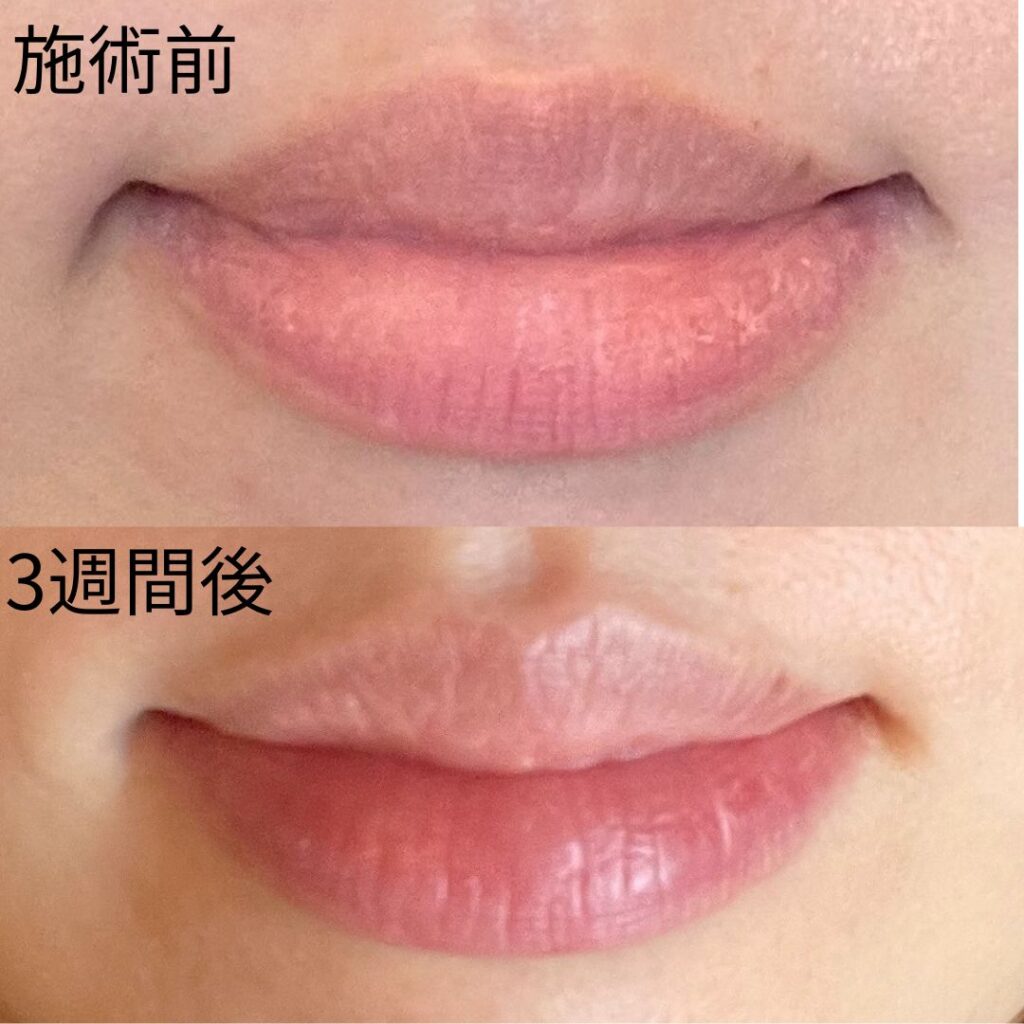 医師解説】ローマピンクはアフタークリームだけでも効果あるかも