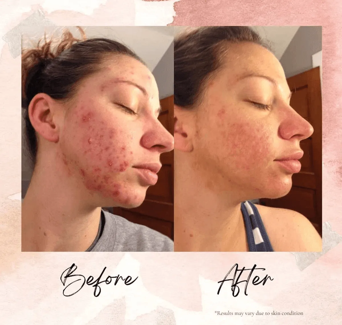 LEROSETT® Organic Acne Kit + Acne Supplements 60-Day Kit