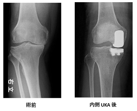 膝スポーツ人工関節センター | 群馬中央病院 | 地域医療機能推進機構