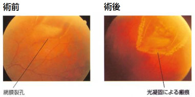 網膜剥離｜水戸市の日帰り手術専門の眼科｜はねもと眼科