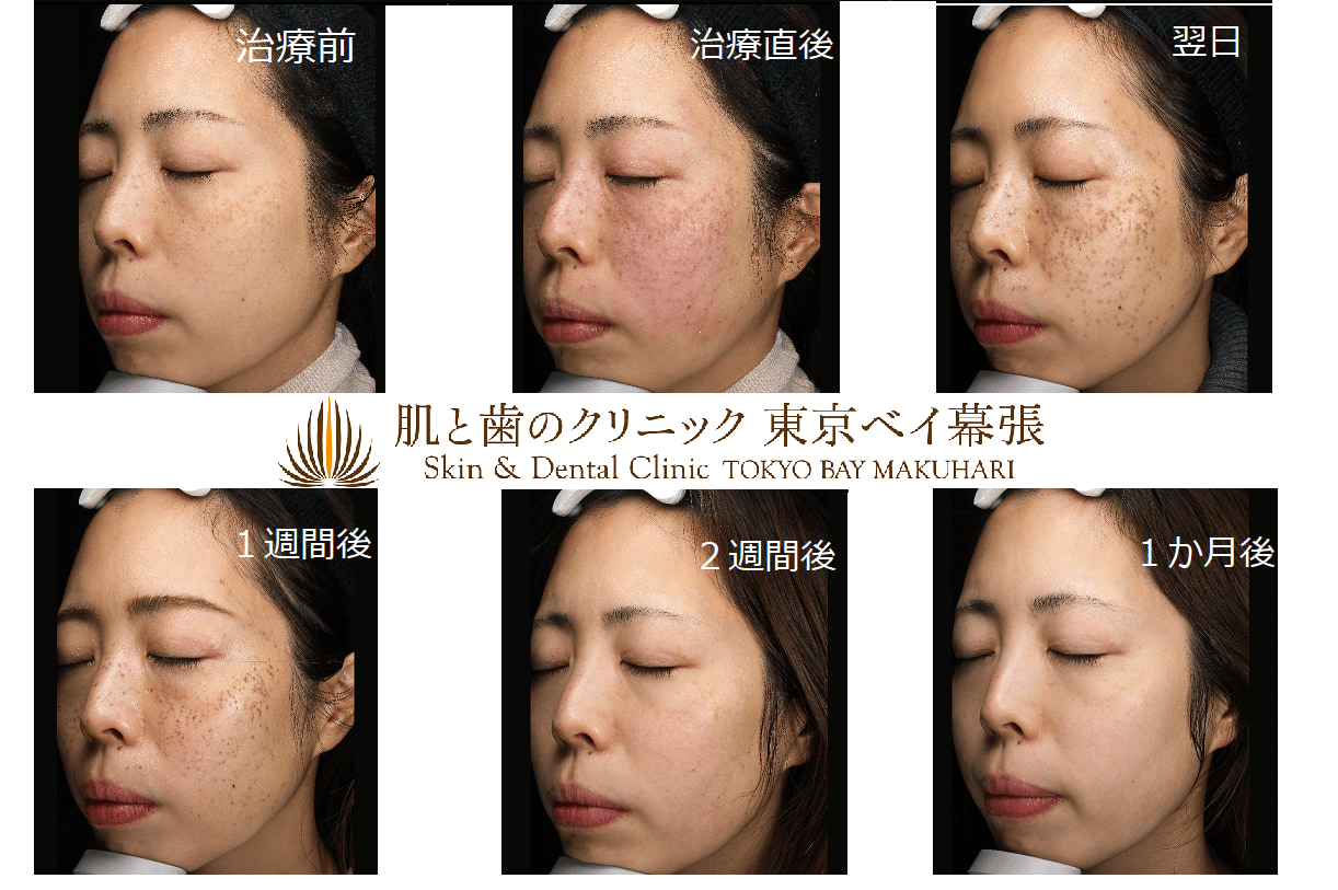 ピコレーザーでのシミ取り1ヶ月の治療経過について | 肌と歯の