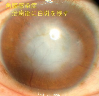 角膜感染症｜尼崎市宮内町にある萩原眼科クリニック