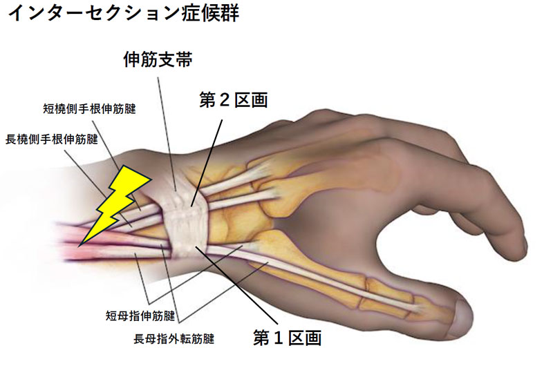 スポーツ外傷／障害｜はっとり整形外科・リウマチ科クリニック
