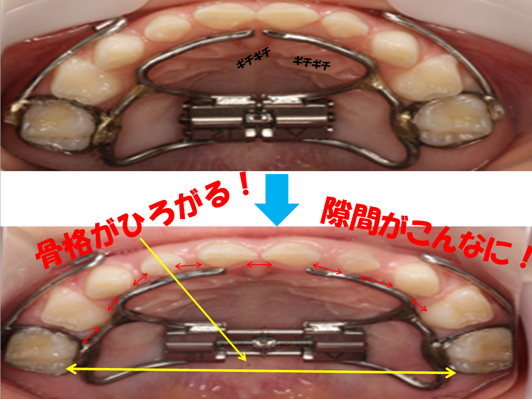 矯正 で使っている 装置 ！紹介します！！ - 岩見沢の歯医者なら鳩が丘