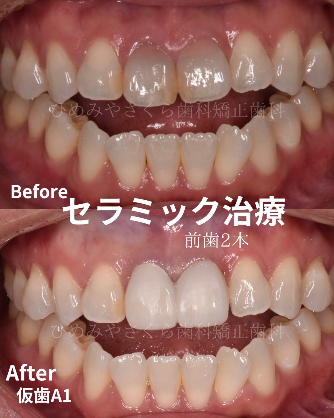 11月, 2024 | 名古屋市の歯医者は「ひめみやさくら歯科矯正歯科」