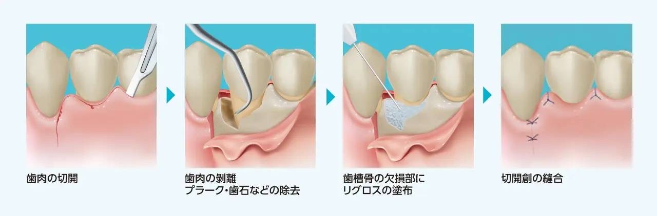 歯周組織再生療法について | 日野市で人気の歯科・歯医者/・日野本町