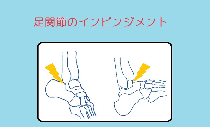 足関節インピンジメント症候群ってなんだ？