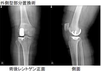 人工膝関節置換術について｜整形外科｜診療部門のご案内｜日野市立病院