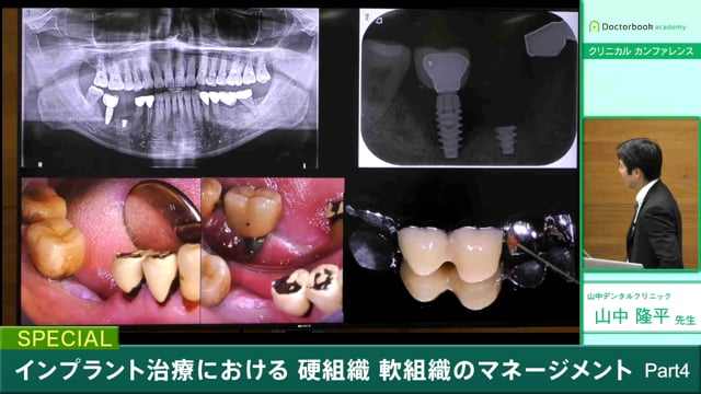 インプラント治療における硬組織、軟組織のマネージメント