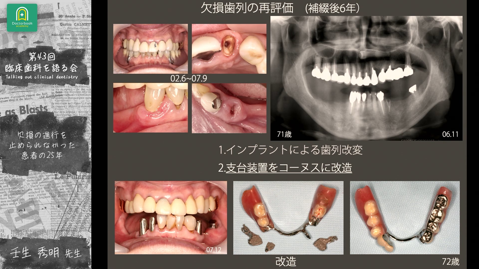 欠損の進行を止められなかった患者の25年｜第43回 臨床歯科を語る会