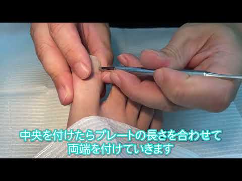 巻き爪矯正専門院シーライク - YouTube