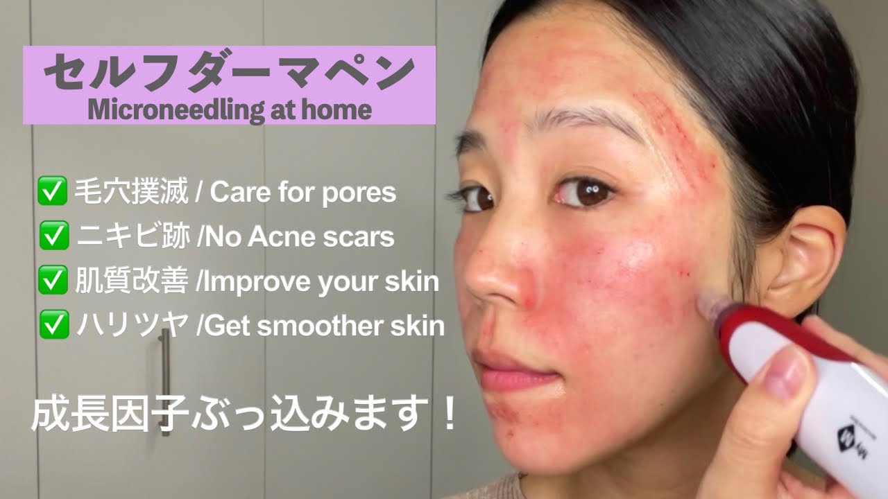 Here's how I got microneedling treatment at home using growth