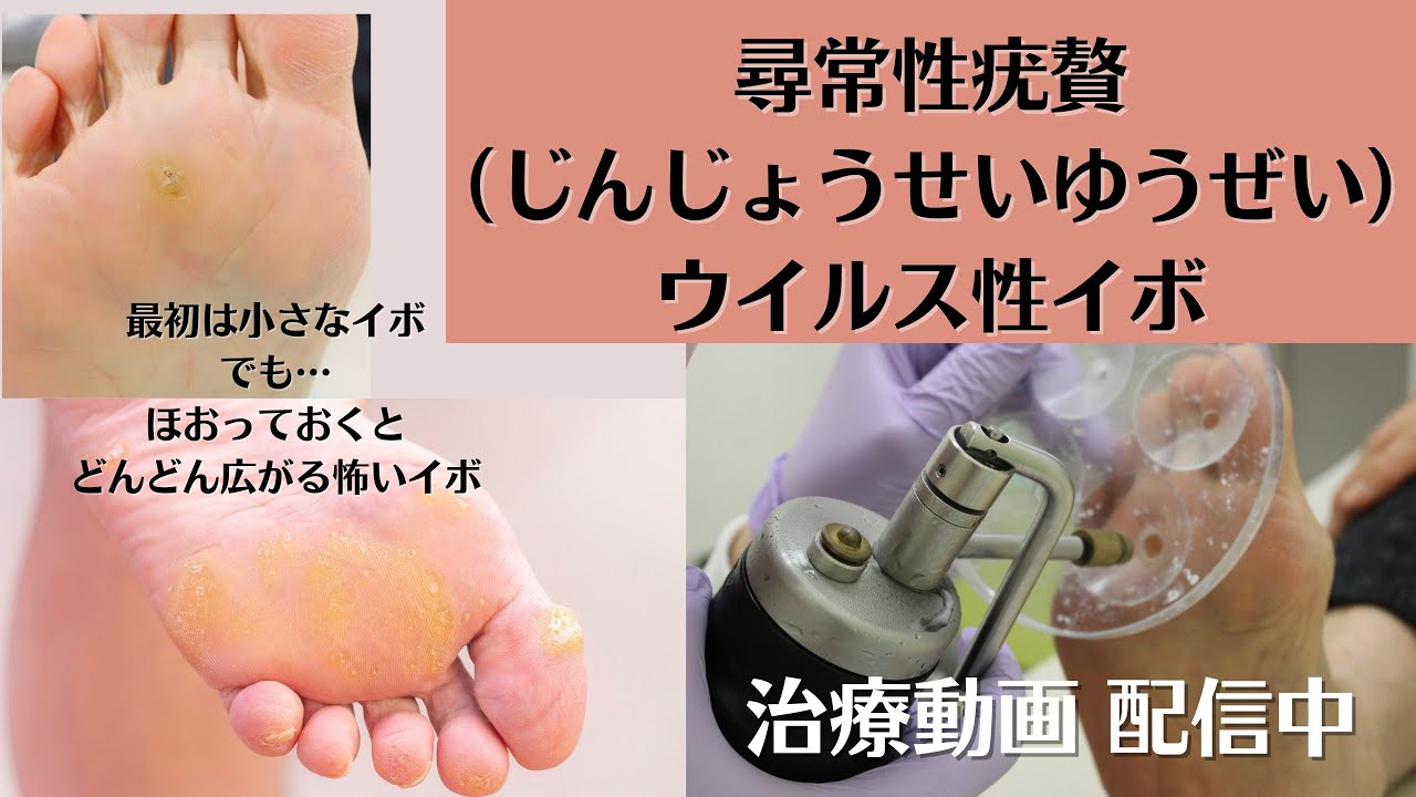 Actual treatment video included] What are viral warts (verruca