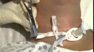 カニューレホルダー - 株式会社名優