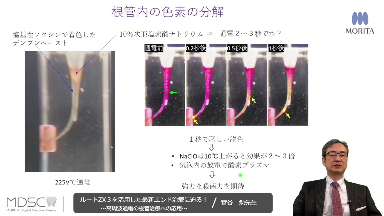 モリタ】高周波通電による発熱部位と難治性根尖性歯周炎への応用