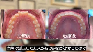 Orthodontics] Crooked and crooked front teeth | 22-year-old female