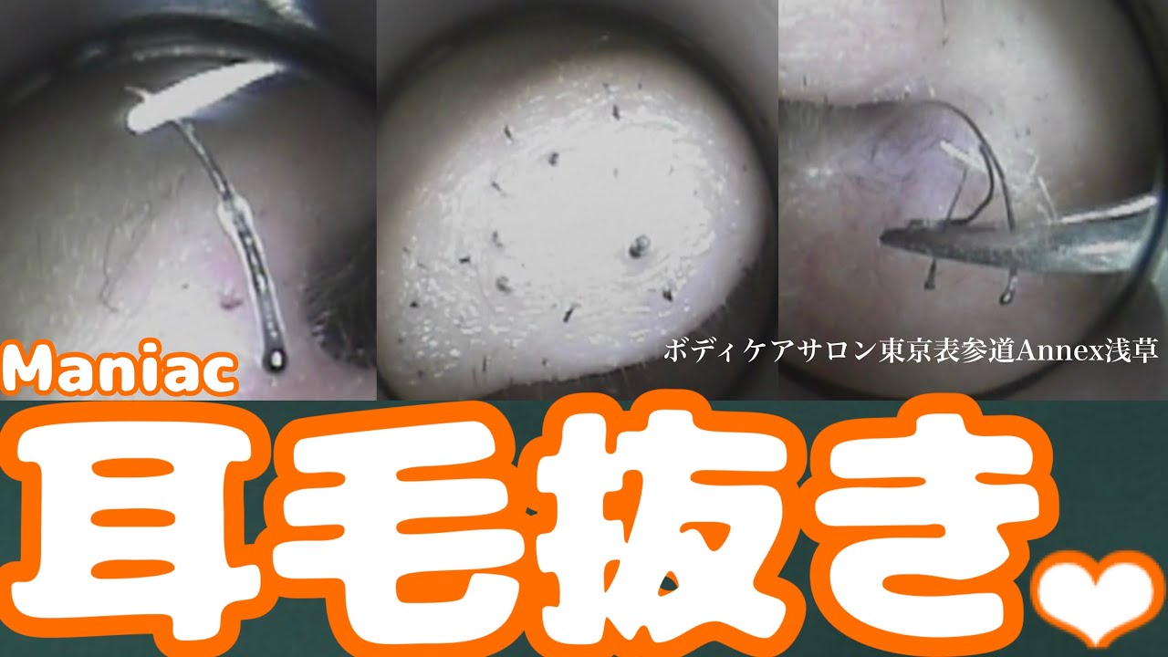 193 #耳毛 除毛💛#ピンセット #耳掃除 #耳かき #japaneseearcleaning