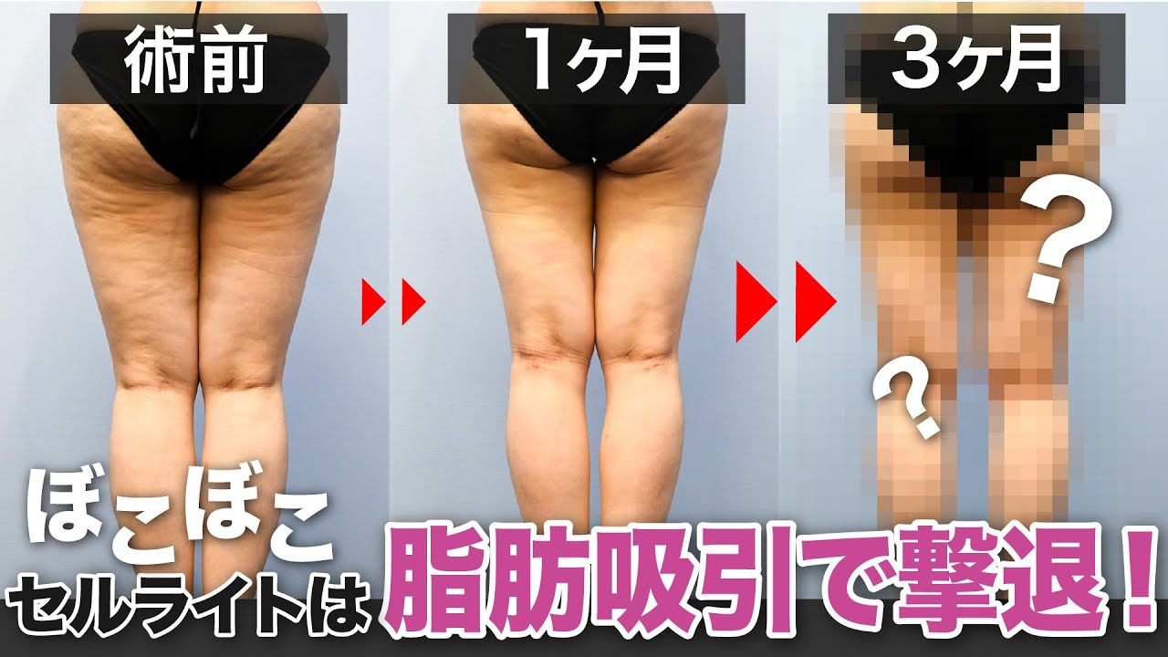 セルライト除去】究極の足痩せするならやっぱり脂肪吸引 - YouTube