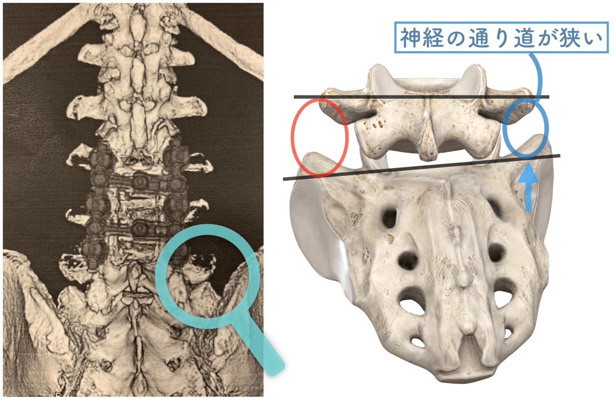腰部脊柱管狭窄症 手術後も続く症状に対しての手技の介入 | にしむら治療院