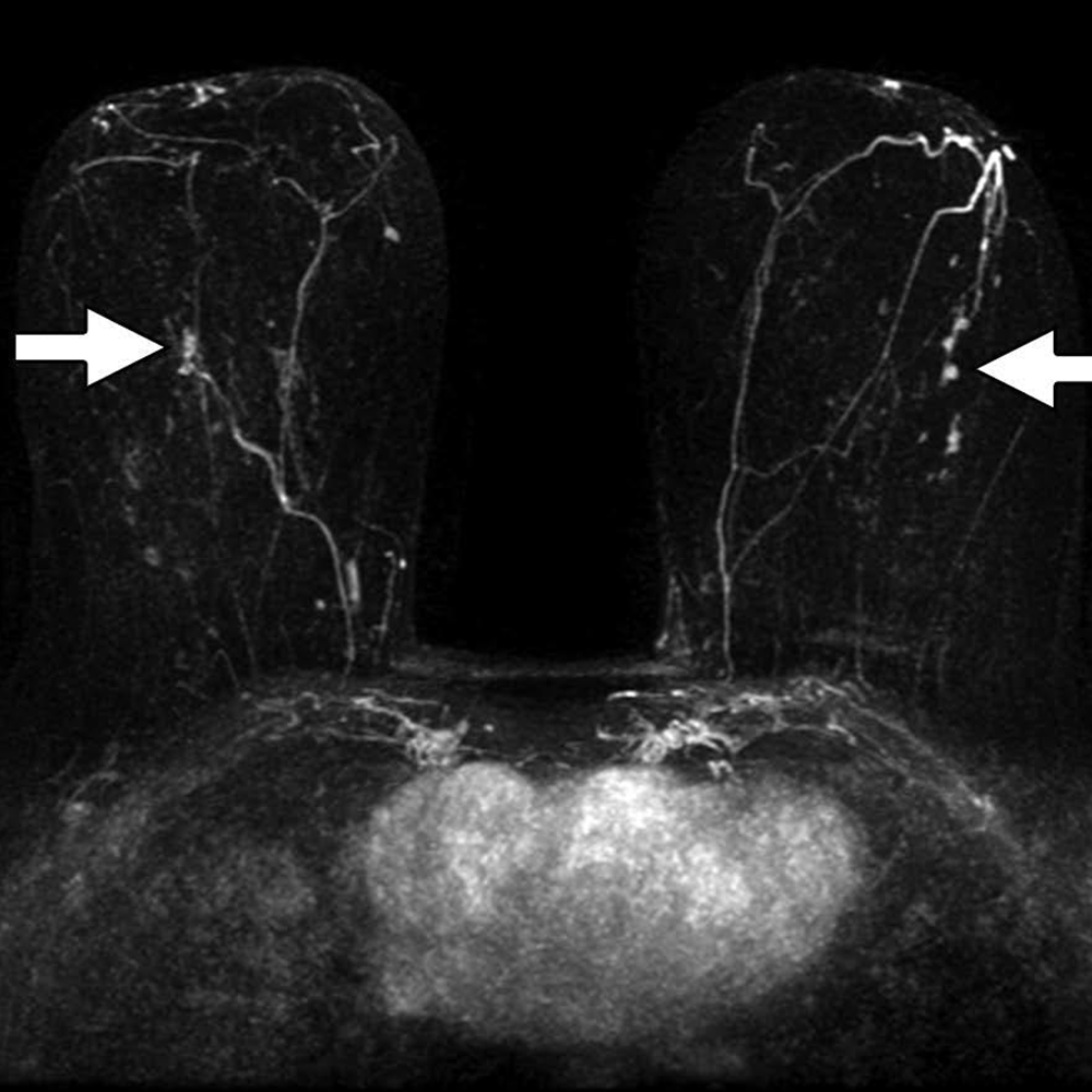 Abbreviated Breast MRI for Supplemental Screening: The Why and How