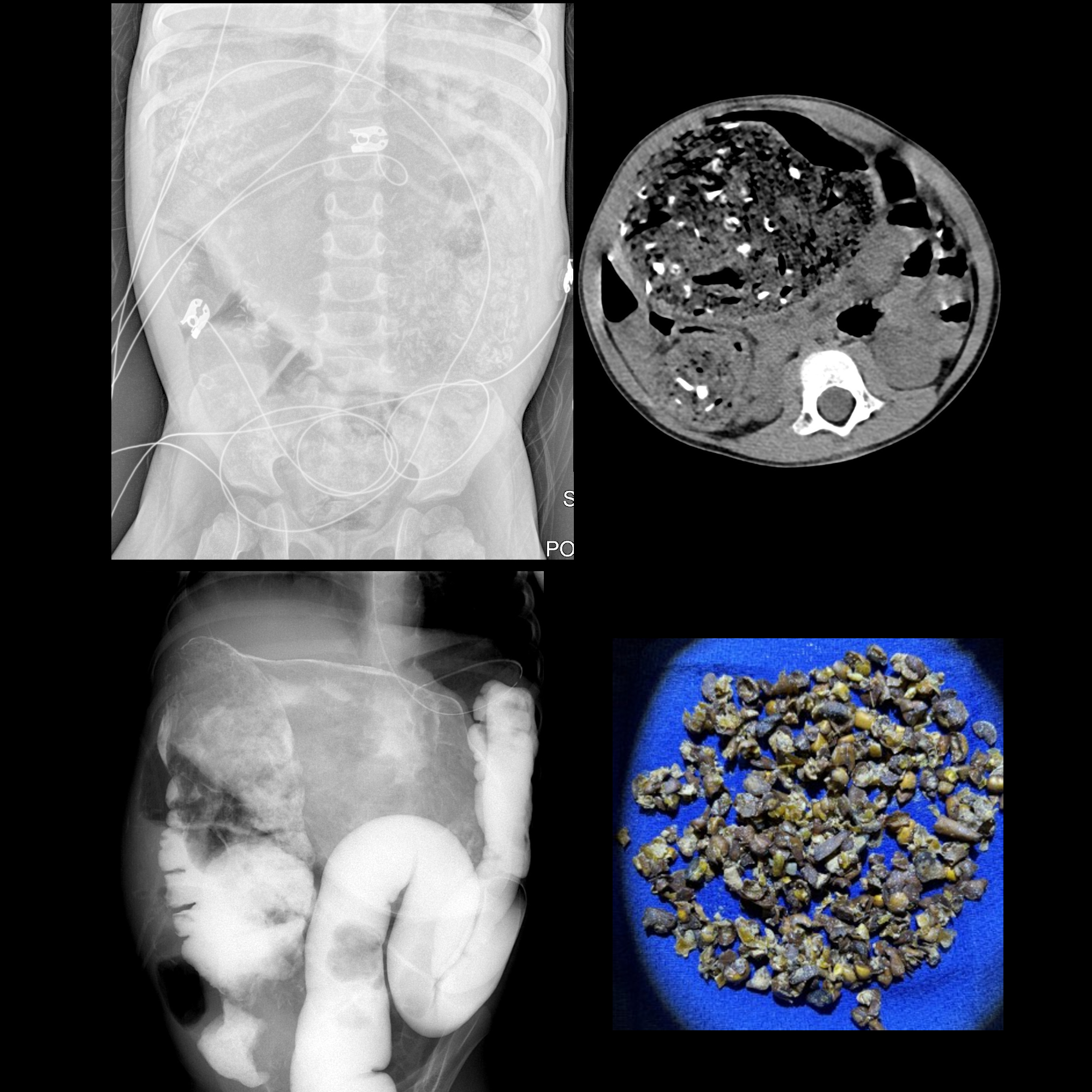 necrotizingenterocolitis05mdab