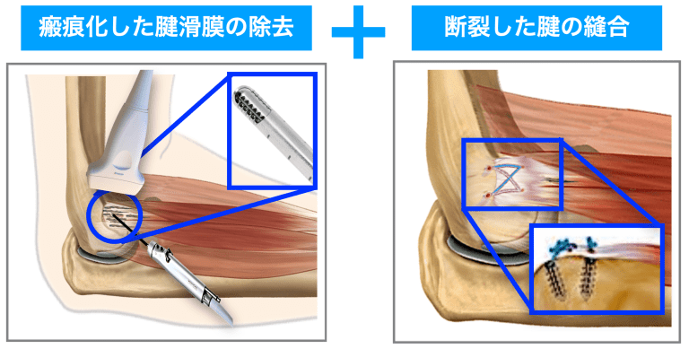 テニス肘・上腕骨外側上顆炎の治療法 再生医療 もやもや血管 炎症血管