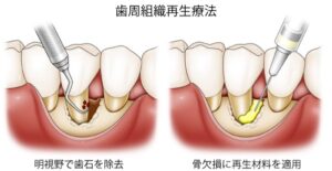 歯周組織再生剤リグロスは魔法のクスリ！？ | 新発田市の歯科医院 いい