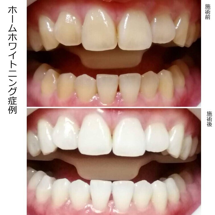 ホームホワイトニング | 札幌デンタルケア | ホットペッパービューティー