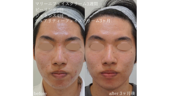 デュアリティーフェイスクリーム+マリーニフェイスクリーム+ピーリング