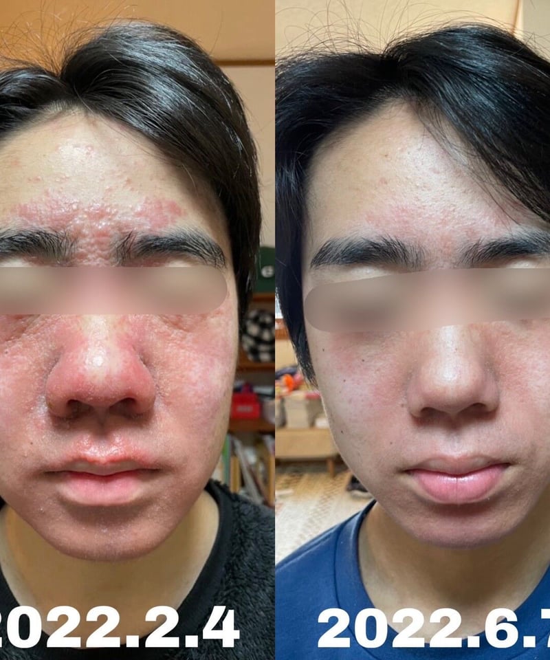 アズイリス炭酸パック 100g | unic's STORE