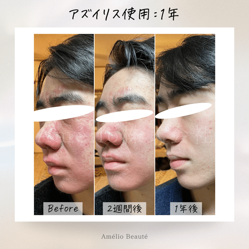 アズイリス 【As_iris】 炭酸ガスペーストパック 経皮吸収剤