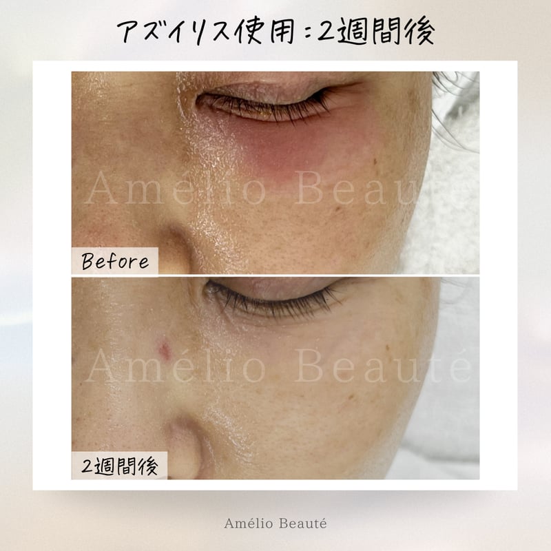 送料無料✨️アズイリス（As_iris）＋アズルクス《炭酸パック