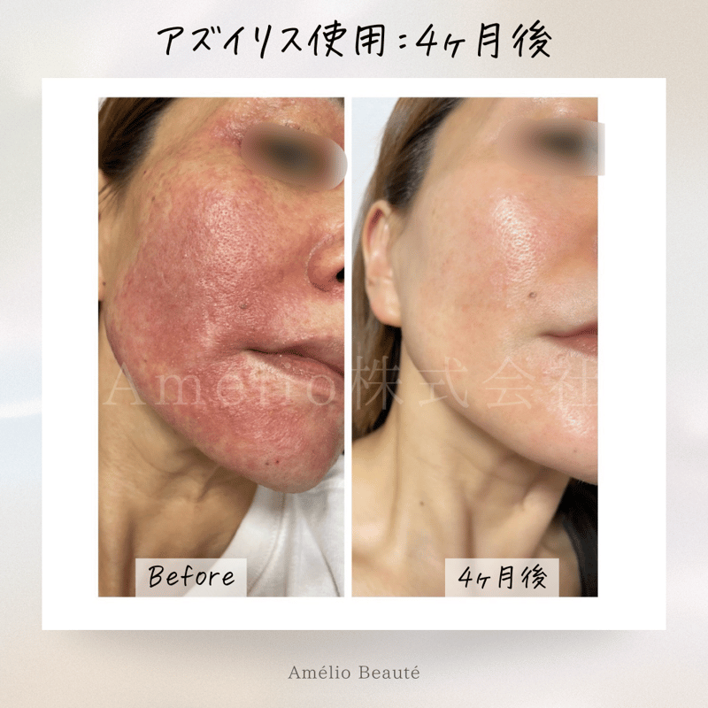 アズイリス＋アズシエル【炭酸ガスパック 肌質改善・保湿クリーム