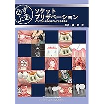 必ず上達 ソケットプリザベーション: インプラント初心者でもできる骨