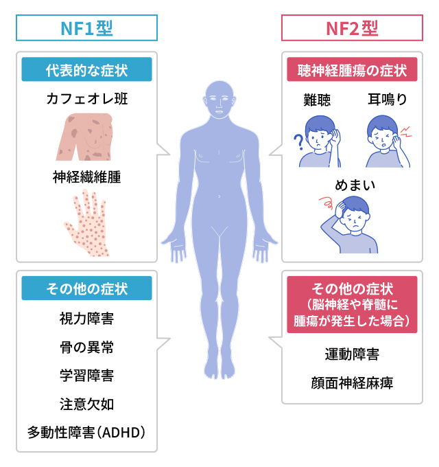 神経線維腫症ではどのような症状がありますか？ ｜神経線維腫症